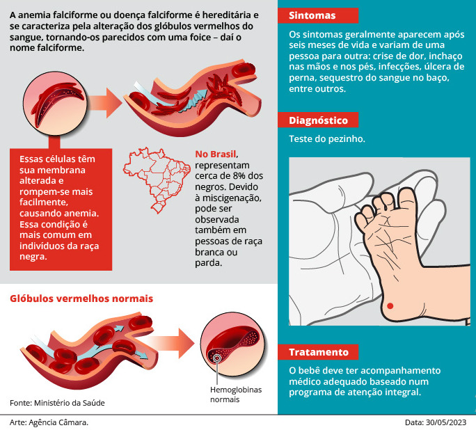 Doença Falciforme - Diagnostico